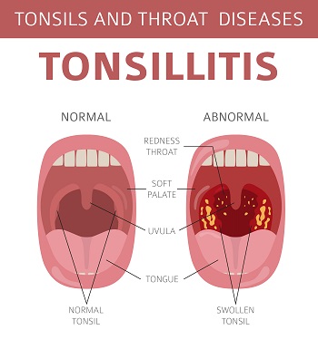 Signs of Tonsillitis - Ears, Nose and Throat Clinic San Antonio
